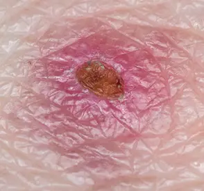 Spider Bite