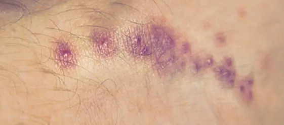 Scabies Appearance