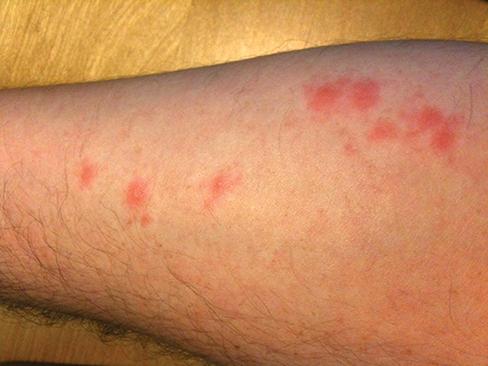 Picture of bed bug bites on skin
